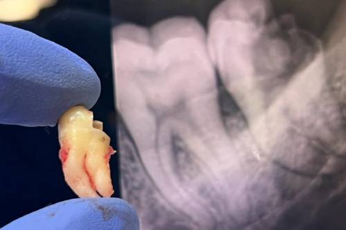 Cirugía de terceros molares o muelas del juicio