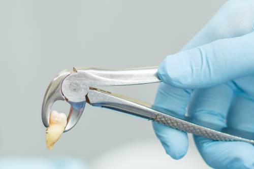 Extracciones dentales